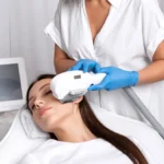 Photofacial treatment process – A close-up of an IPL photofacial treatment in progress, showing the Venus Versa device in action.