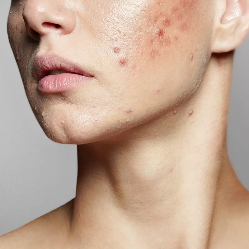 adult acne