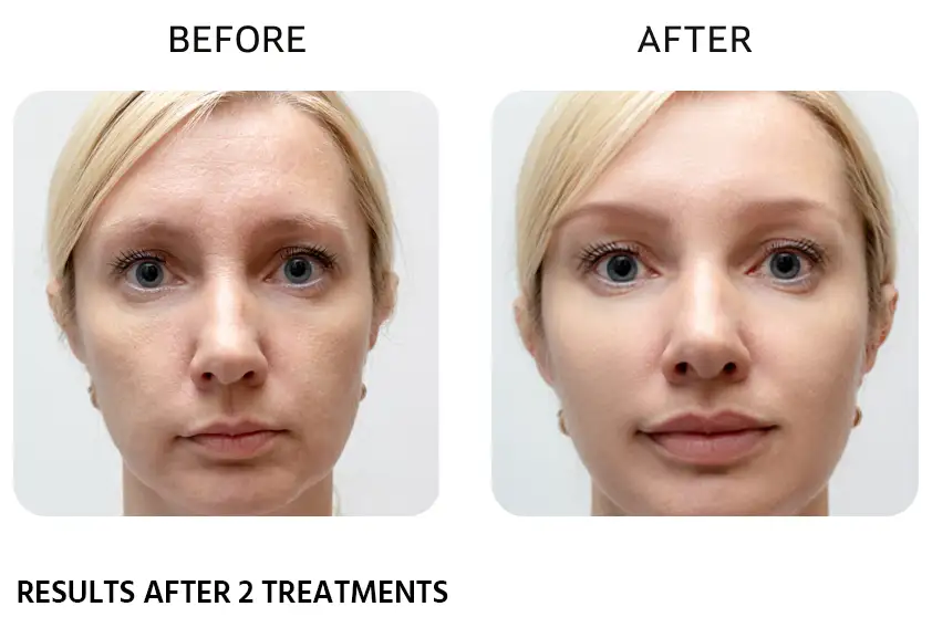 Physician Grade Chemical Peels Rochester NY