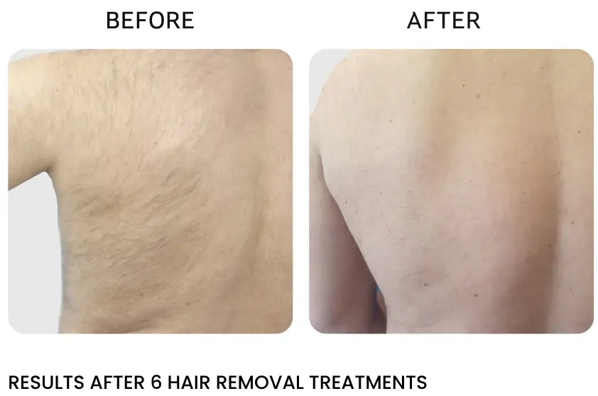 laser hair removal process