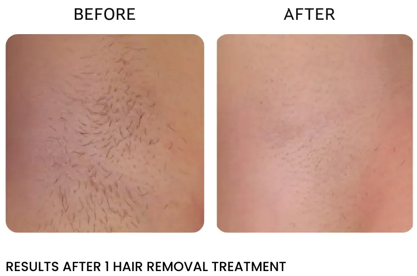 rochester laser hair removal