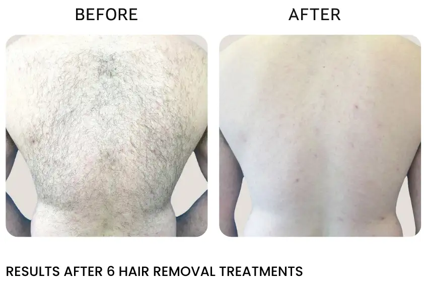 laser back hair removal