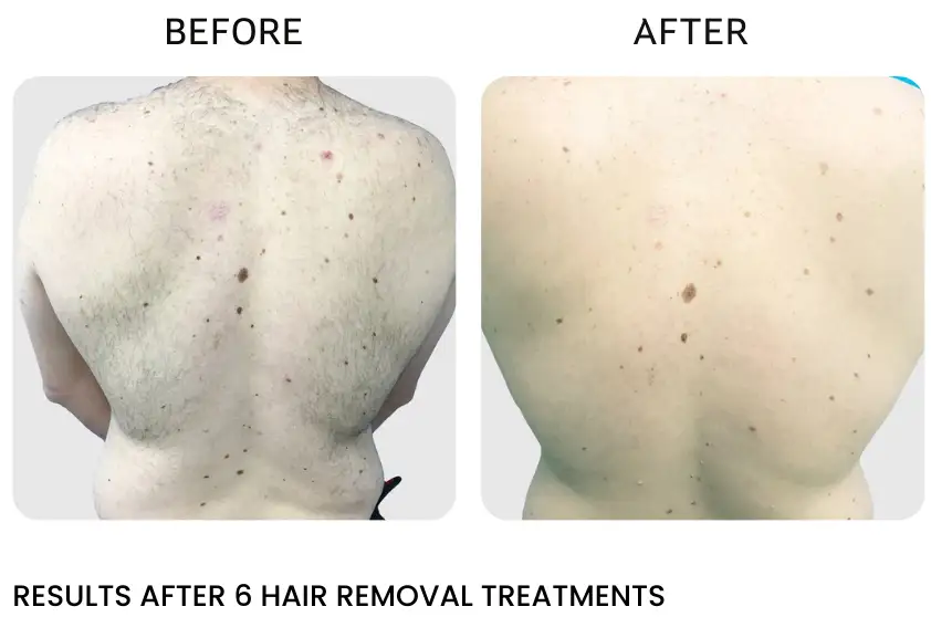 laser back hair removal