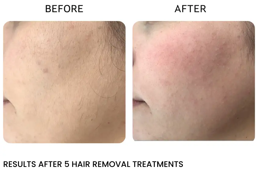 laser hair removal process Rochester NY