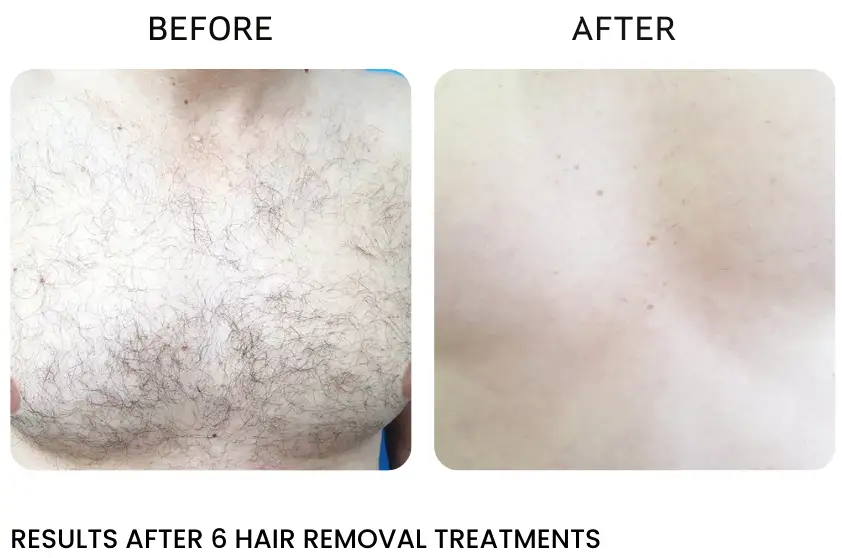 best laser hair removal near me