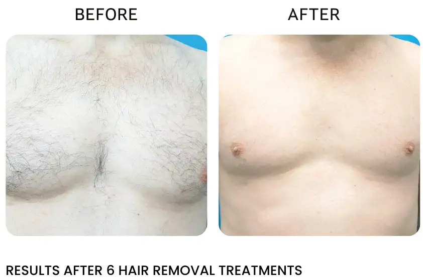 best laser hair removal Rochester NY