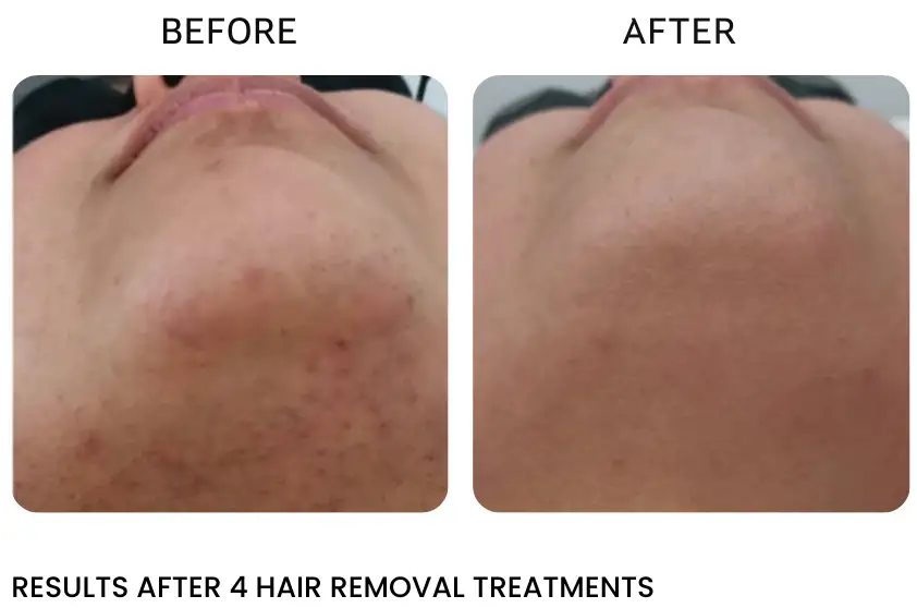 upper lip laser hair removal near me