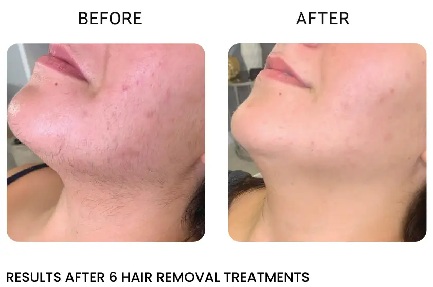 laser hair removal on face near me