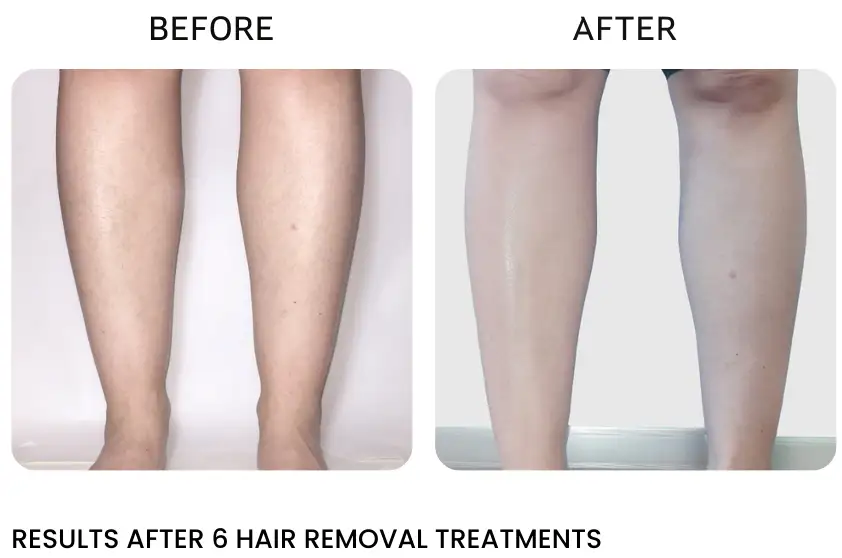 laser hair removal for legs