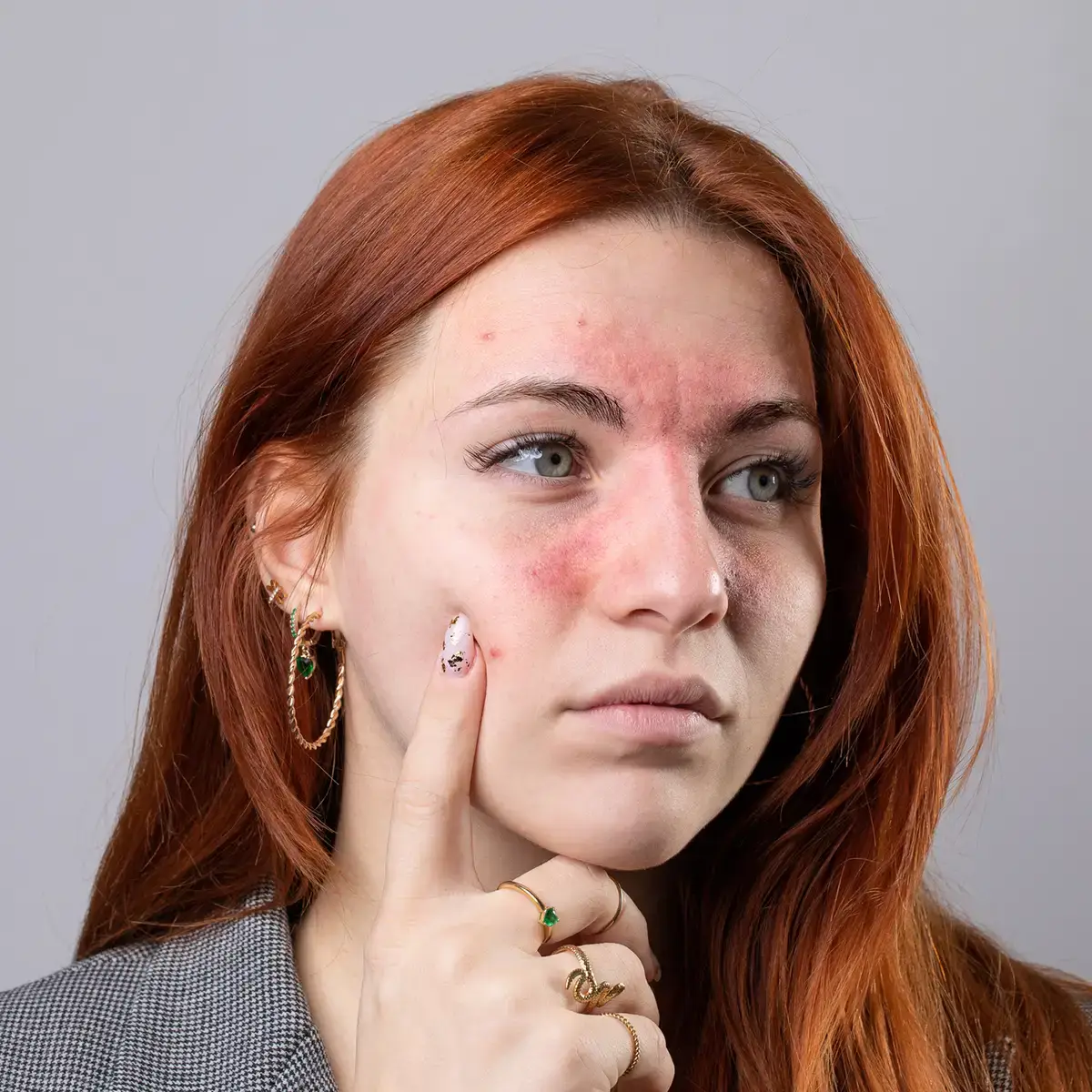 rosacea face treatment