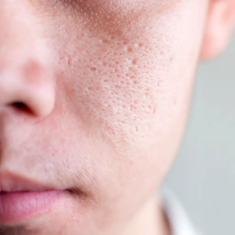 Tailored Treatments for Large Pores at Refresh MedSpa