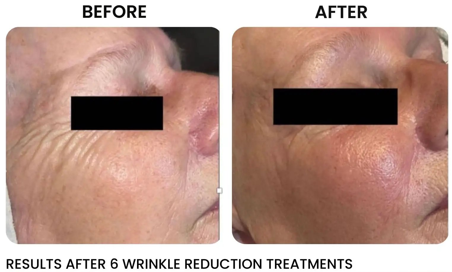 Laser Skin Tightening Rochester NY