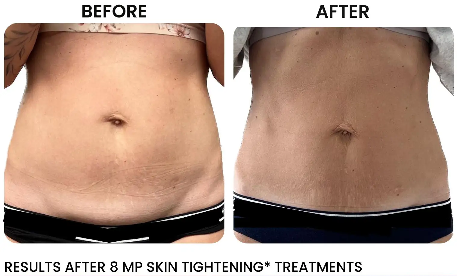 Laser and Skin Rejuvenation for stretch marks near me