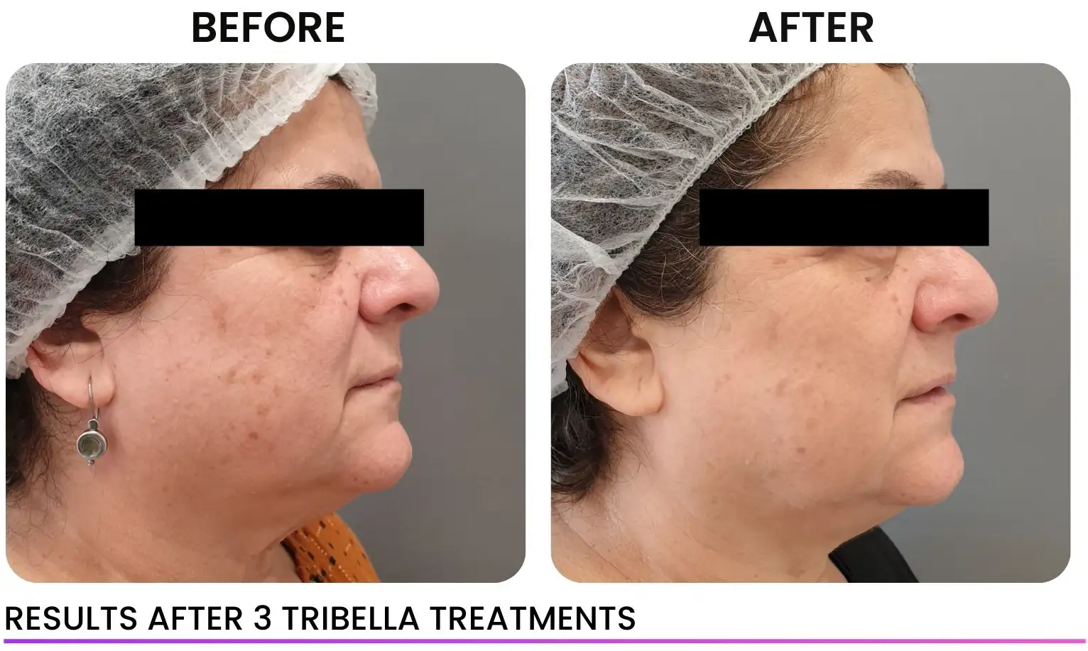 Tribella-Skin-Texture