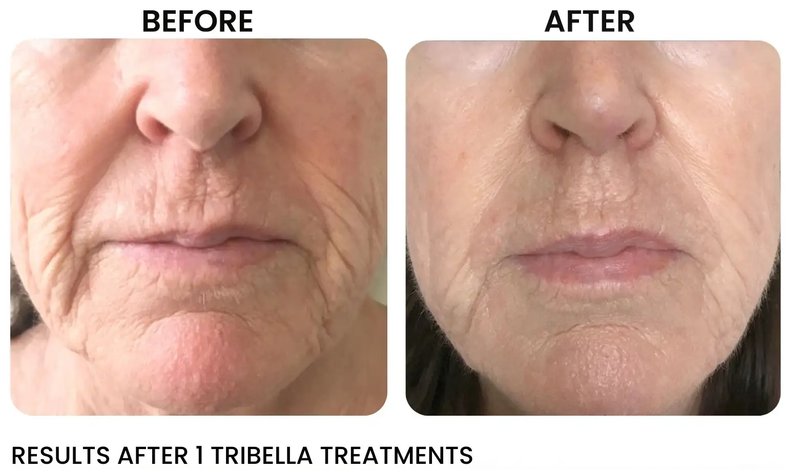 laser resurfacing face