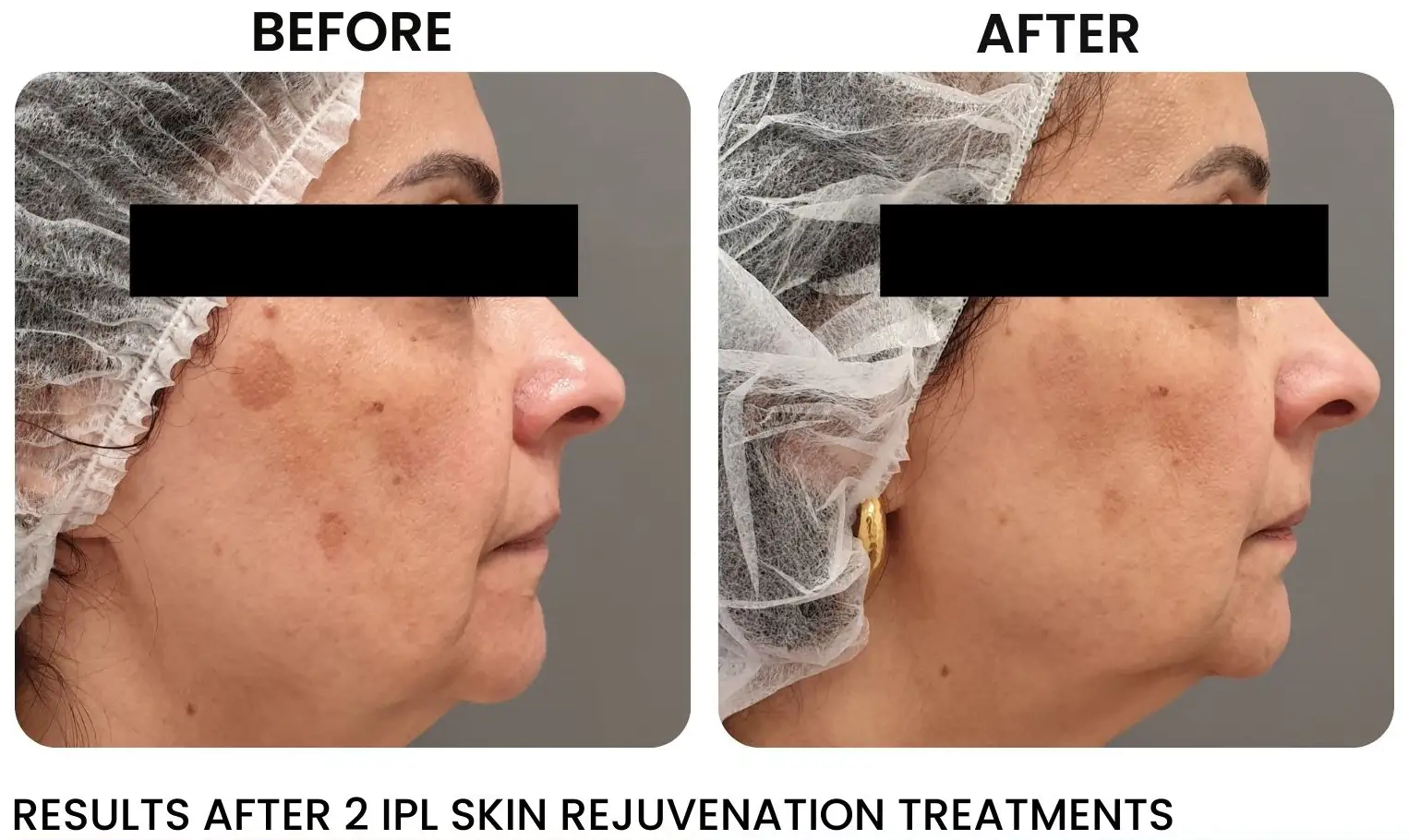 Versa Pro 2 IPL Skin rejuvenation1