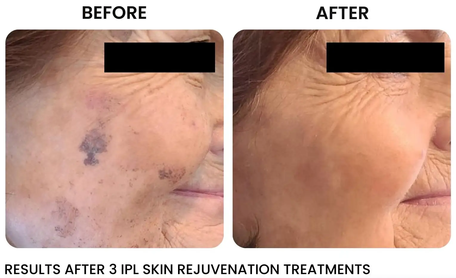 Versa Pro 2 IPL Skin rejuvenation2