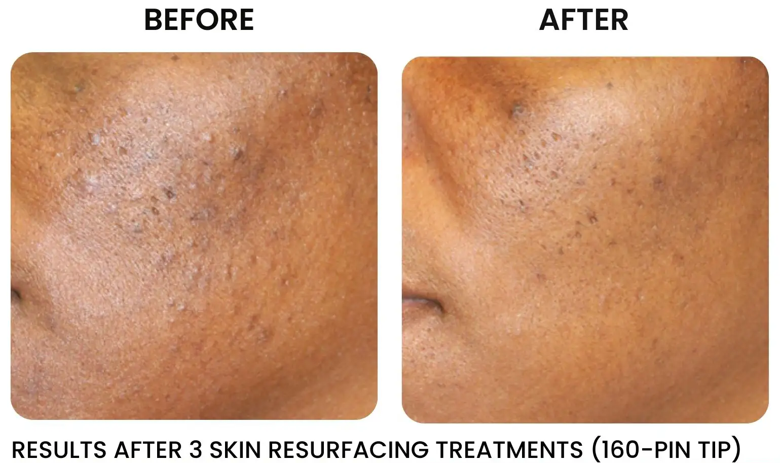 IPL Skin rejuvenation near me