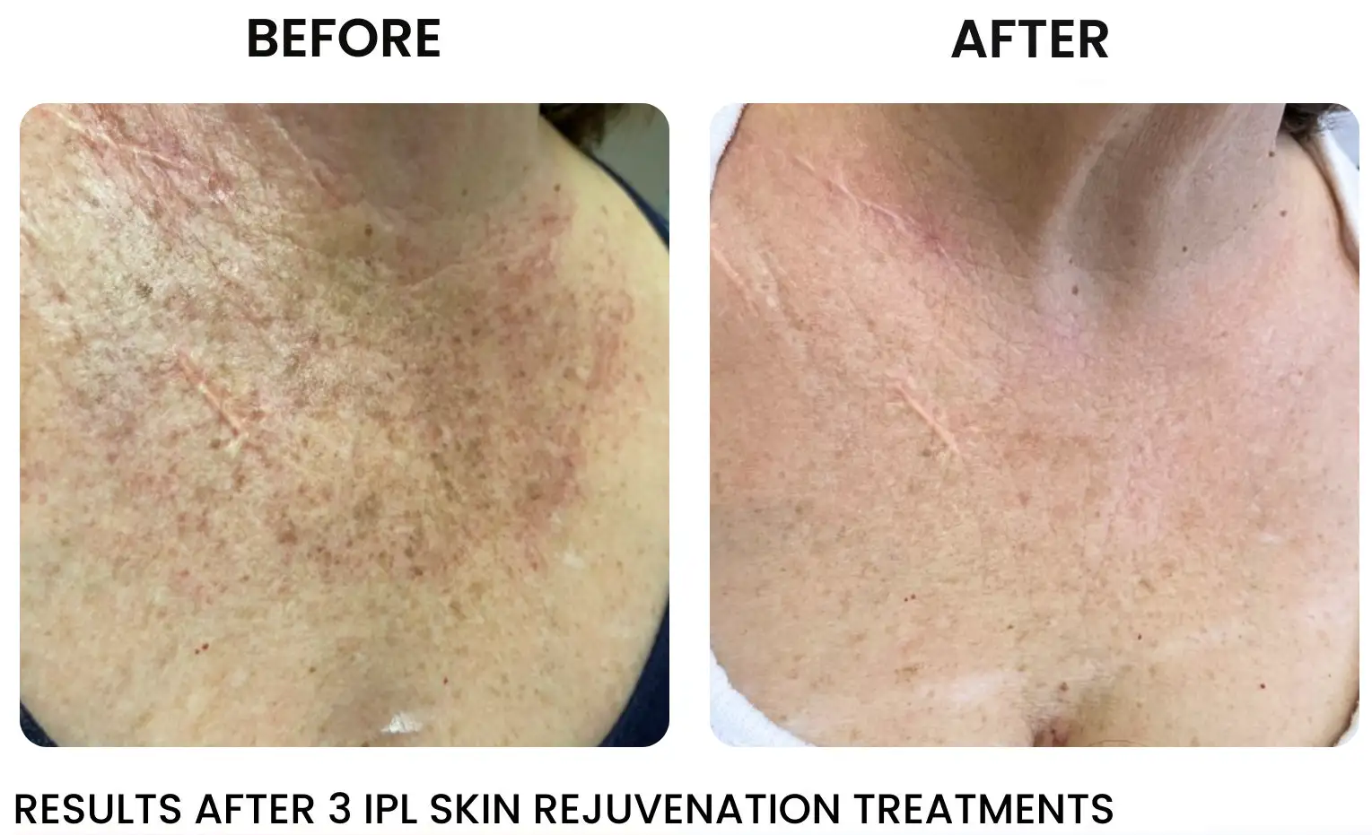 Scar resurfacing near me