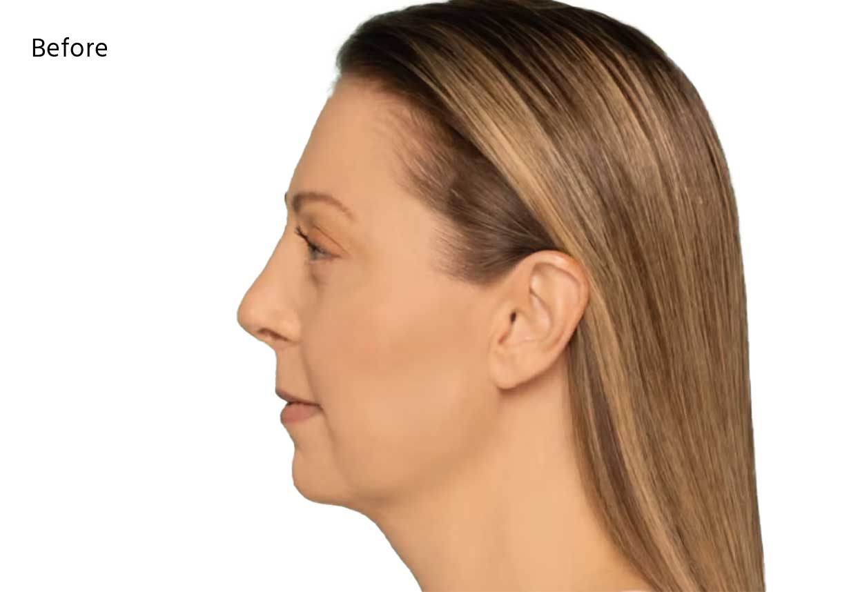 facial fillers near me