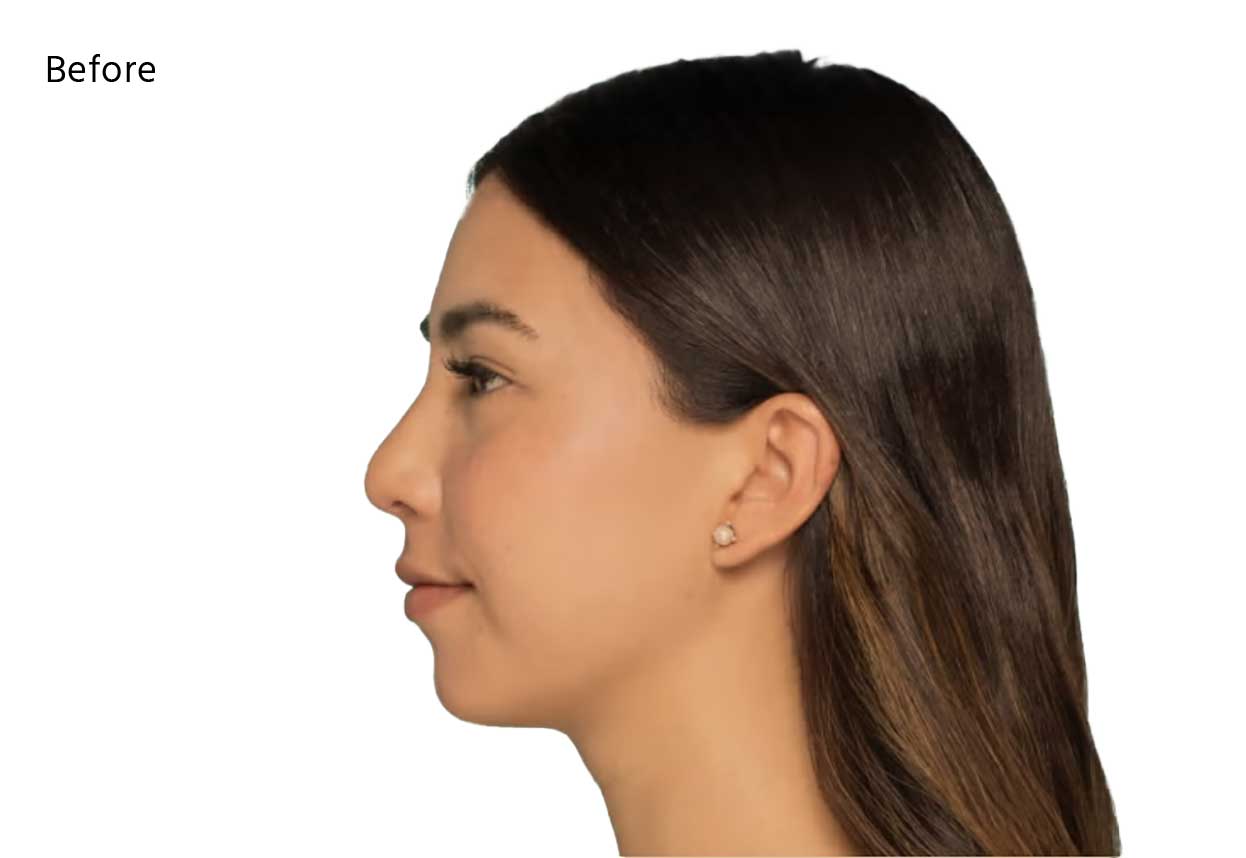 facial fillers for the chin near me