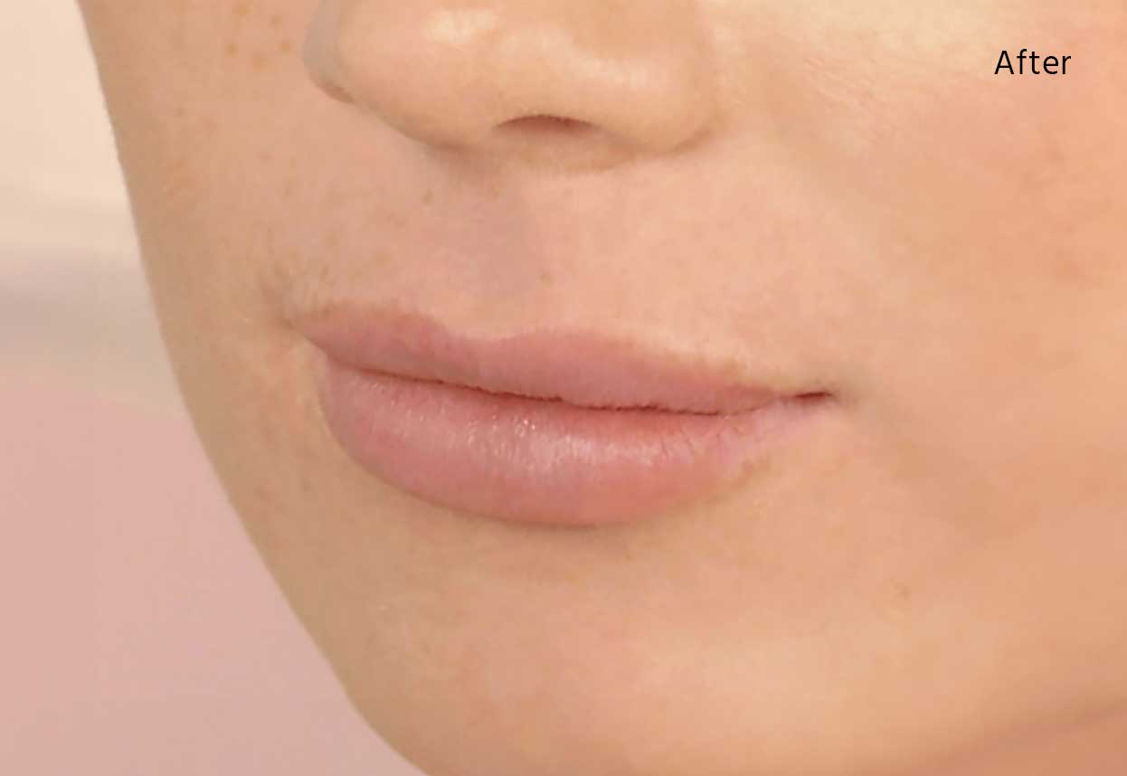 lip filler rochester ny