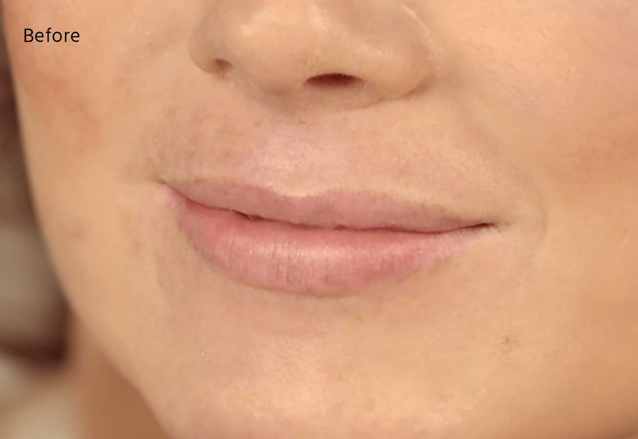 juvederm rochester ny