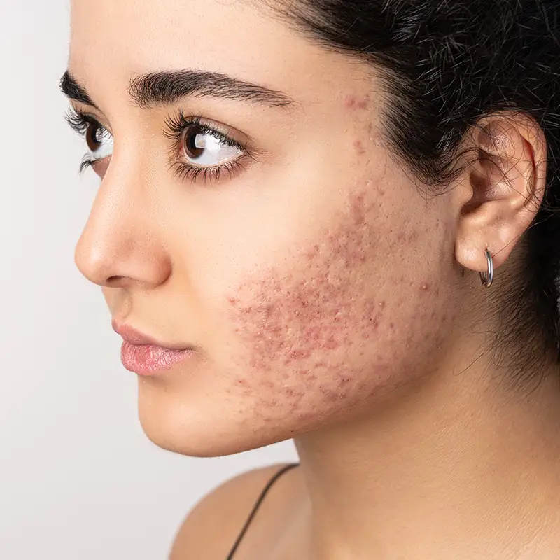 Acne Scar Treatments